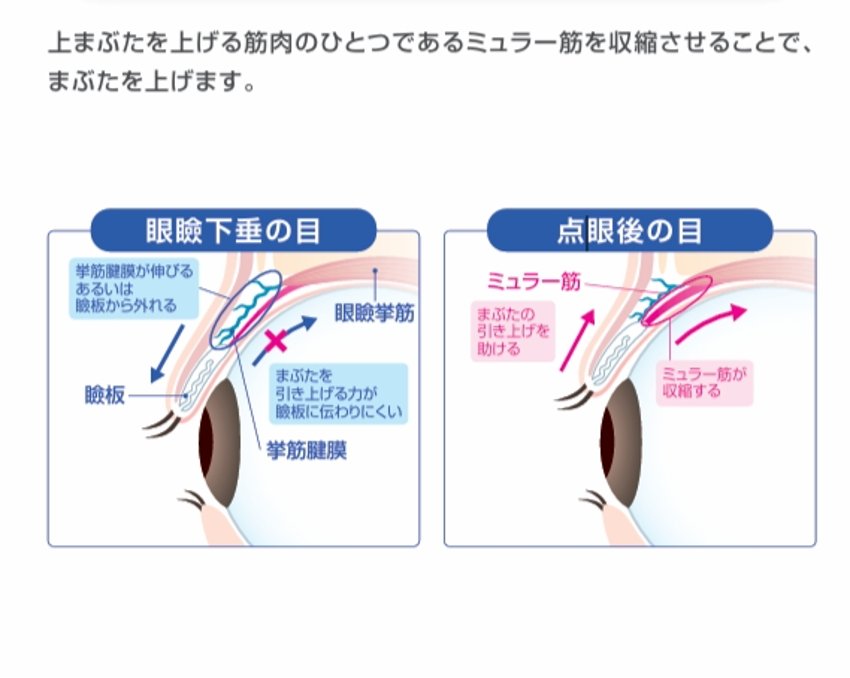 眼瞼下垂の薬物療法