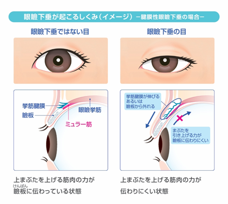 眼瞼下垂とは